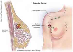 Симптомы рака молочной железы: первые признаки рака молочной железы